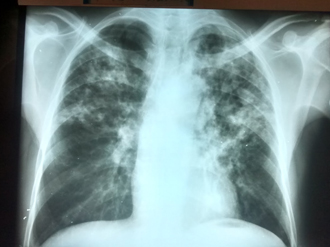 A chest X-ray