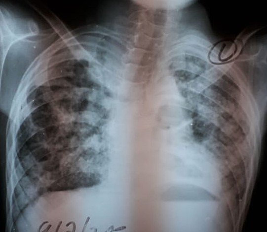 An X-ray of somone with TB with bullae