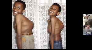A young surgical patient before and after work on his back.