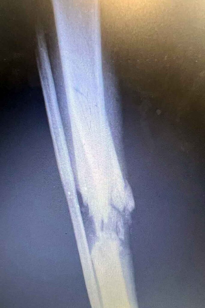 X-ray showing a severe fracture of a patient's lower leg