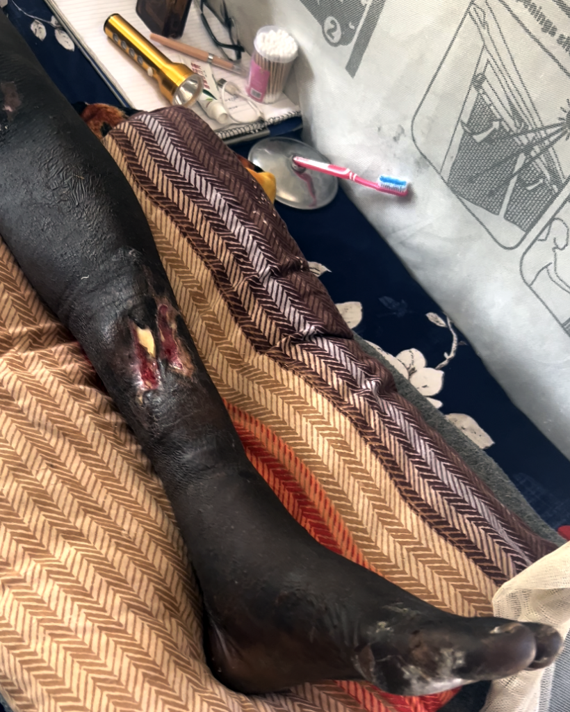 Patient's lower leg recovering after surgery at Mother of Mercy Hospital